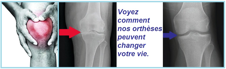 Voyez comment nos orthèses peuvent changer votre vie.